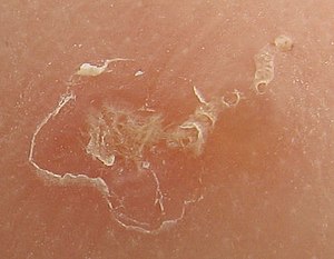 Officials Investigating Scabies Outbreak At Nursing Facility