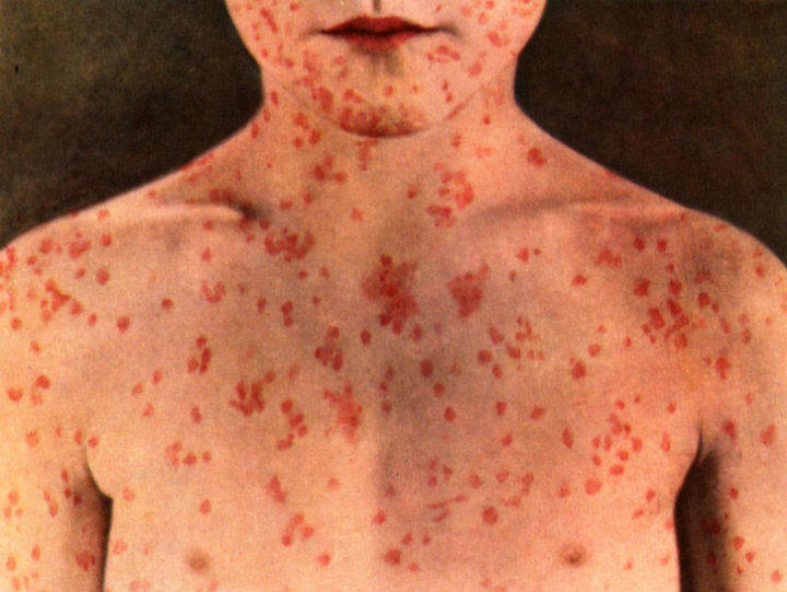 Maine confirms first case of measles in 2 years